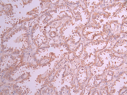 IHC image of CSB-RA579787A0HU diluted at 1:100 and staining in paraffin-embedded human lung cancer performed on a Leica BondTM system. After dewaxing and hydration, antigen retrieval was mediated by high pressure in a citrate buffer (pH 6.0) . Section was blocked with 10% normal goat serum 30min at RT. Then primary antibody (1% BSA) was incubated at 4°C overnight. The primary is detected by a Goat anti-rabbit polymer IgG labeled by HRP and visualized using 0.05% DAB.