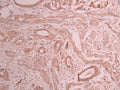 IHC image of CSB-RA585966A0HU diluted at 1:100 and staining in paraffin-embedded human cervical cancer performed on a Leica BondTM system. After dewaxing and hydration, antigen retrieval was mediated by high pressure in a citrate buffer (pH 6.0) . Section was blocked with 10% normal goat serum 30min at RT. Then primary antibody (1% BSA) was incubated at 4°C overnight. The primary is detected by a Goat anti-rabbit polymer IgG labeled by HRP and visualized using 0.05% DAB.
