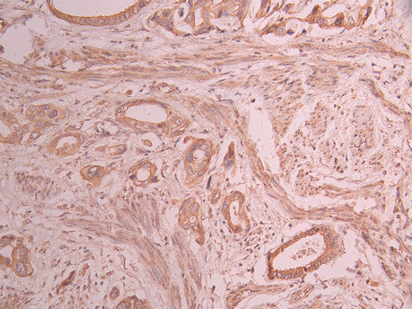IHC image of CSB-RA585966A0HU diluted at 1:100 and staining in paraffin-embedded human cervical cancer performed on a Leica BondTM system. After dewaxing and hydration, antigen retrieval was mediated by high pressure in a citrate buffer (pH 6.0) . Section was blocked with 10% normal goat serum 30min at RT. Then primary antibody (1% BSA) was incubated at 4°C overnight. The primary is detected by a Goat anti-rabbit polymer IgG labeled by HRP and visualized using 0.05% DAB.