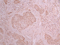 IHC image of CSB-RA599206A0HU diluted at 1:100 and staining in paraffin-embedded human pancreatic cancer performed on a Leica BondTM system. After dewaxing and hydration, antigen retrieval was mediated by high pressure in a citrate buffer (pH 6.0) . Section was blocked with 10% normal goat serum 30min at RT. Then primary antibody (1% BSA) was incubated at 4°C overnight. The primary is detected by a Goat anti-rabbit polymer IgG labeled by HRP and visualized using 0.05% DAB.