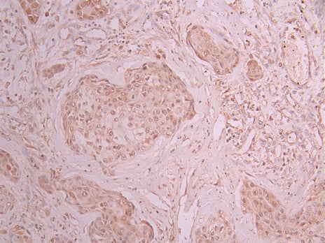 IHC image of CSB-RA599206A0HU diluted at 1:100 and staining in paraffin-embedded human pancreatic cancer performed on a Leica BondTM system. After dewaxing and hydration, antigen retrieval was mediated by high pressure in a citrate buffer (pH 6.0) . Section was blocked with 10% normal goat serum 30min at RT. Then primary antibody (1% BSA) was incubated at 4°C overnight. The primary is detected by a Goat anti-rabbit polymer IgG labeled by HRP and visualized using 0.05% DAB.