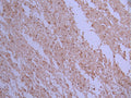 IHC image of CSB-RA599252A0HU diluted at 1:100 and staining in paraffin-embedded human glioma cancer performed on a Leica BondTM system. After dewaxing and hydration, antigen retrieval was mediated by high pressure in a citrate buffer (pH 6.0) . Section was blocked with 10% normal goat serum 30min at RT. Then primary antibody (1% BSA) was incubated at 4°C overnight. The primary is detected by a Goat anti-rabbit polymer IgG labeled by HRP and visualized using 0.05% DAB.