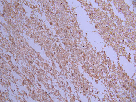IHC image of CSB-RA599252A0HU diluted at 1:100 and staining in paraffin-embedded human glioma cancer performed on a Leica BondTM system. After dewaxing and hydration, antigen retrieval was mediated by high pressure in a citrate buffer (pH 6.0) . Section was blocked with 10% normal goat serum 30min at RT. Then primary antibody (1% BSA) was incubated at 4°C overnight. The primary is detected by a Goat anti-rabbit polymer IgG labeled by HRP and visualized using 0.05% DAB.