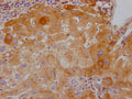 IHC image of CSB-RA599469A0HU diluted at 1:100 and staining in paraffin-embedded human liver cancer performed on a Leica BondTM system. After dewaxing and hydration, antigen retrieval was mediated by high pressure in a citrate buffer (pH 6.0) . Section was blocked with 10% normal goat serum 30min at RT. Then primary antibody (1% BSA) was incubated at 4℃ overnight. The primary is detected by a Goat anti-rabbit IgG polymer labeled by HRP and visualized using 0.05% DAB.