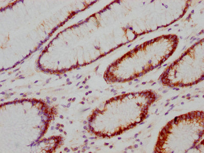 IHC image of CSB-RA614990A0HU diluted at 1:118 and staining in paraffin-embedded human gastric cancer performed on a Leica BondTM system. After dewaxing and hydration, antigen retrieval was mediated by high pressure in a citrate buffer (pH 6.0) . Section was blocked with 10% normal goat serum 30min at RT. Then primary antibody (1% BSA) was incubated at 4℃ overnight. The primary is detected by a biotinylated secondary antibody and visualized using an HRP conjugated SP system.