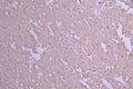 IHC image of CSB-RA616977A0HU diluted at 1:100 and staining in paraffin-embedded human glioma cancer performed on a Leica BondTM system. After dewaxing and hydration, antigen retrieval was mediated by high pressure in a citrate buffer (pH 6.0) . Section was blocked with 10% normal goat serum 30min at RT. Then primary antibody (1% BSA) was incubated at 4°C overnight. The primary is detected by a Goat anti-rabbit polymer IgG labeled by HRP and visualized using 0.05% DAB.