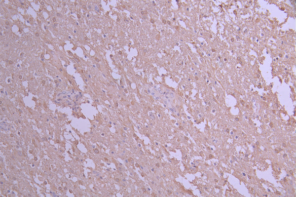 IHC image of CSB-RA616977A0HU diluted at 1:100 and staining in paraffin-embedded human glioma cancer performed on a Leica BondTM system. After dewaxing and hydration, antigen retrieval was mediated by high pressure in a citrate buffer (pH 6.0) . Section was blocked with 10% normal goat serum 30min at RT. Then primary antibody (1% BSA) was incubated at 4°C overnight. The primary is detected by a Goat anti-rabbit polymer IgG labeled by HRP and visualized using 0.05% DAB.