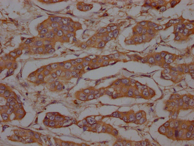 IHC image of CSB-RA634199A0HU diluted at 1:100 and staining in paraffin-embedded human breast cancer performed on a Leica BondTM system. After dewaxing and hydration, antigen retrieval was mediated by high pressure in a citrate buffer (pH 6.0) . Section was blocked with 10% normal goat serum 30min at RT. Then primary antibody (1% BSA) was incubated at 4℃ overnight. The primary is detected by a Goat anti-rabbit IgG polymer labeled by HRP and visualized using 0.05% DAB.