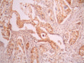 IHC image of CSB-RA644699A0HU diluted at 1:100 and staining in paraffin-embedded human pancreatic cancer performed on a Leica BondTM system. After dewaxing and hydration, antigen retrieval was mediated by high pressure in a citrate buffer (pH 6.0). Section was blocked with 10% normal goat serum 30min at RT. Then primary antibody (1% BSA) was incubated at 4°C overnight. The primary is detected by a Goat anti-rabbit polymer IgG labeled by HRP and visualized using 0.05% DAB.