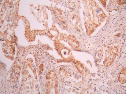 IHC image of CSB-RA644699A0HU diluted at 1:100 and staining in paraffin-embedded human pancreatic cancer performed on a Leica BondTM system. After dewaxing and hydration, antigen retrieval was mediated by high pressure in a citrate buffer (pH 6.0). Section was blocked with 10% normal goat serum 30min at RT. Then primary antibody (1% BSA) was incubated at 4°C overnight. The primary is detected by a Goat anti-rabbit polymer IgG labeled by HRP and visualized using 0.05% DAB.