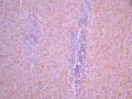 IHC image of CSB-RA67589MA1HU diluted at 1:50 and staining in paraffin-embedded human liver cancer performed on a Leica BondTM system. After dewaxing and hydration, antigen retrieval was mediated by high pressure in a citrate buffer (pH 6.0). Section was blocked with 10% normal goat serum 30min at RT. Then primary antibody (1% BSA) was incubated at 4°C overnight. The primary is detected by a Anti-Human lgG, Fcy Fragment Specific labeled by HRP and visualized using 0.05% DAB.
