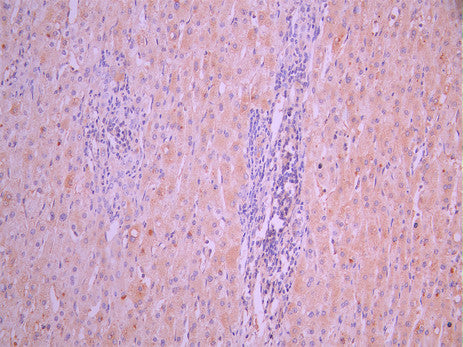 IHC image of CSB-RA67589MA1HU diluted at 1:50 and staining in paraffin-embedded human liver cancer performed on a Leica BondTM system. After dewaxing and hydration, antigen retrieval was mediated by high pressure in a citrate buffer (pH 6.0). Section was blocked with 10% normal goat serum 30min at RT. Then primary antibody (1% BSA) was incubated at 4°C overnight. The primary is detected by a Anti-Human lgG, Fcy Fragment Specific labeled by HRP and visualized using 0.05% DAB.