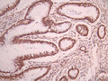 IHC image of CSB-RA679623A0HU diluted at 1:100 and staining in paraffin-embedded human gastric cancer performed on a Leica BondTM system. After dewaxing and hydration, antigen retrieval was mediated by high pressure in a citrate buffer (pH 6.0). Section was blocked with 10% normal goat serum 30min at RT. Then primary antibody (1% BSA) was incubated at 4°C overnight. The primary is detected by a Goat anti-rabbit polymer IgG labeled by HRP and visualized using 0.05% DAB.