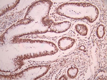 IHC image of CSB-RA679623A0HU diluted at 1:100 and staining in paraffin-embedded human gastric cancer performed on a Leica BondTM system. After dewaxing and hydration, antigen retrieval was mediated by high pressure in a citrate buffer (pH 6.0). Section was blocked with 10% normal goat serum 30min at RT. Then primary antibody (1% BSA) was incubated at 4°C overnight. The primary is detected by a Goat anti-rabbit polymer IgG labeled by HRP and visualized using 0.05% DAB.