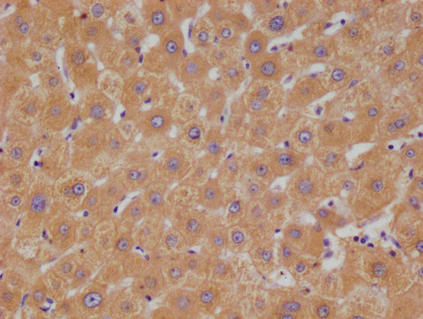 IHC image of CSB-RA695552A0HU diluted at 1:100 and staining in paraffin-embedded human liver cancer performed on a Leica BondTM system. After dewaxing and hydration, antigen retrieval was mediated by high pressure in a citrate buffer (pH 6.0) . Section was blocked with 10% normal goat serum 30min at RT. Then primary antibody (1% BSA) was incubated at 4°C overnight. The primary is detected by a Goat anti-rabbit polymer IgG labeled by HRP and visualized using 0.05% DAB.