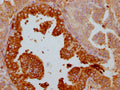 IHC image of CSB-RA697089A0HU diluted at 1:100 and staining in paraffin-embedded human prostate cancer performed on a Leica BondTM system. After dewaxing and hydration, antigen retrieval was mediated by high pressure in a citrate buffer (pH 6.0) . Section was blocked with 10% normal goat serum 30min at RT. Then primary antibody (1% BSA) was incubated at 4℃ overnight. The primary is detected by a Goat anti-rabbit IgG polymer labeled by HRP and visualized using 0.05% DAB.