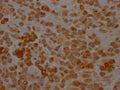 IHC image of CSB-RA699016A0HU diluted at 1:100 and staining in paraffin-embedded human placenta tissue performed on a Leica BondTM system. After dewaxing and hydration, antigen retrieval was mediated by high pressure in a citrate buffer (pH 6.0) . Section was blocked with 10% normal goat serum 30min at RT. Then primary antibody (1% BSA) was incubated at 4℃ overnight. The primary is detected by a Goat anti-rabbit IgG polymer labeled by HRP and visualized using 0.05% DAB.
