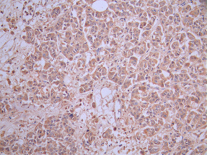 IHC image of CSB-RA761623MA2HU diluted at 1:50 and staining in paraffin-embedded human breast cancer performed on a Leica BondTM system. After dewaxing and hydration, antigen retrieval was mediated by high pressure in a citrate buffer (pH 6.0). Section was blocked with 10% normal goat serum 30min at RT. Then primary antibody (1% BSA) was incubated at 4°C overnight. The primary is detected by a Anti-Human lgG, Fcy Fragment Specific labeled by HRP and visualized using 0.05% DAB.