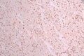 IHC image of CSB-RA778009A0HU diluted at 1:100 and staining in paraffin-embedded human glioma cancer performed on a Leica BondTM system. After dewaxing and hydration, antigen retrieval was mediated by high pressure in a citrate buffer (pH 6.0) . Section was blocked with 10% normal goat serum 30min at RT. Then primary antibody (1% BSA) was incubated at 4°C overnight. The primary is detected by a Goat anti-rabbit polymer IgG labeled by HRP and visualized using 0.05% DAB.