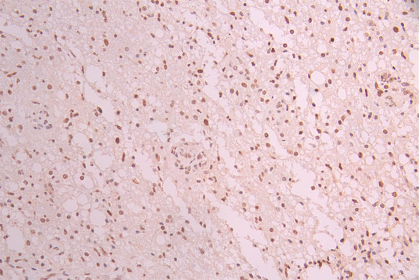IHC image of CSB-RA778009A0HU diluted at 1:100 and staining in paraffin-embedded human glioma cancer performed on a Leica BondTM system. After dewaxing and hydration, antigen retrieval was mediated by high pressure in a citrate buffer (pH 6.0) . Section was blocked with 10% normal goat serum 30min at RT. Then primary antibody (1% BSA) was incubated at 4°C overnight. The primary is detected by a Goat anti-rabbit polymer IgG labeled by HRP and visualized using 0.05% DAB.