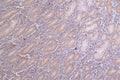 IHC image of CSB-RA782732A0HU diluted at 1:100 and staining in paraffin-embedded human breast cancer performed on a Leica BondTM system. After dewaxing and hydration, antigen retrieval was mediated by high pressure in a citrate buffer (pH 6.0) . Section was blocked with 10% normal goat serum 30min at RT. Then primary antibody (1% BSA) was incubated at 4°C overnight. The primary is detected by a Goat anti-rabbit polymer IgG labeled by HRP and visualized using 0.69% DAB.