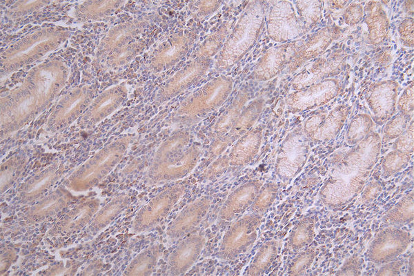IHC image of CSB-RA782732A0HU diluted at 1:100 and staining in paraffin-embedded human breast cancer performed on a Leica BondTM system. After dewaxing and hydration, antigen retrieval was mediated by high pressure in a citrate buffer (pH 6.0) . Section was blocked with 10% normal goat serum 30min at RT. Then primary antibody (1% BSA) was incubated at 4°C overnight. The primary is detected by a Goat anti-rabbit polymer IgG labeled by HRP and visualized using 0.69% DAB.