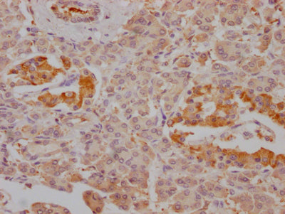 IHC image of CSB-RA787345A0HU diluted at 1:100 and staining in paraffin-embedded human pancreatic tissue performed on a Leica BondTM system. After dewaxing and hydration, antigen retrieval was mediated by high pressure in a citrate buffer (pH 6.0) . Section was blocked with 10% normal goat serum 30min at RT. Then primary antibody (1% BSA) was incubated at 4℃ overnight. The primary is detected by a Goat anti-rabbit IgG polymer labeled by HRP and visualized using 0.05% DAB.