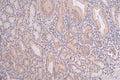 IHC image of CSB-RA792403A0HU diluted at 1:100 and staining in paraffin-embedded human gastric cancer performed on a Leica BondTM system. After dewaxing and hydration, antigen retrieval was mediated by high pressure in a citrate buffer (pH 6.0) . Section was blocked with 10% normal goat serum 30min at RT. Then primary antibody (1% BSA) was incubated at 4°C overnight. The primary is detected by a Goat anti-rabbit polymer IgG labeled by HRP and visualized using 0.06% DAB.