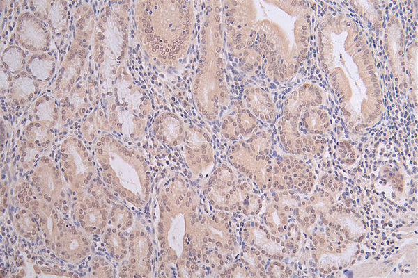 IHC image of CSB-RA792403A0HU diluted at 1:100 and staining in paraffin-embedded human gastric cancer performed on a Leica BondTM system. After dewaxing and hydration, antigen retrieval was mediated by high pressure in a citrate buffer (pH 6.0) . Section was blocked with 10% normal goat serum 30min at RT. Then primary antibody (1% BSA) was incubated at 4°C overnight. The primary is detected by a Goat anti-rabbit polymer IgG labeled by HRP and visualized using 0.06% DAB.