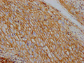 IHC image of CSB-RA796310A0HU diluted at 1:100 and staining in paraffin-embedded human liver cancer performed on a Leica BondTM system. After dewaxing and hydration, antigen retrieval was mediated by high pressure in a citrate buffer (pH 6.0) . Section was blocked with 10% normal goat serum 30min at RT. Then primary antibody (1% BSA) was incubated at 4℃ overnight. The primary is detected by a Goat anti-rabbit IgG polymer labeled by HRP and visualized using 0.05% DAB.