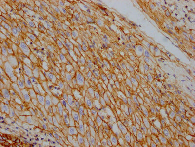 IHC image of CSB-RA796310A0HU diluted at 1:100 and staining in paraffin-embedded human liver cancer performed on a Leica BondTM system. After dewaxing and hydration, antigen retrieval was mediated by high pressure in a citrate buffer (pH 6.0) . Section was blocked with 10% normal goat serum 30min at RT. Then primary antibody (1% BSA) was incubated at 4℃ overnight. The primary is detected by a Goat anti-rabbit IgG polymer labeled by HRP and visualized using 0.05% DAB.
