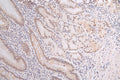 IHC image of CSB-RA796958A0HU diluted at 1:50 and staining in paraffin-embedded human gastric cancer performed on a Leica BondTM system. After dewaxing and hydration, antigen retrieval was mediated by high pressure in a citrate buffer (pH 6.0) . Section was blocked with 10% normal goat serum 30min at RT. Then primary antibody (1% BSA) was incubated at 4°C overnight. The primary is detected by a Goat anti-rabbit polymer IgG labeled by HRP and visualized using 0.67% DAB.