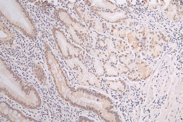 IHC image of CSB-RA796958A0HU diluted at 1:50 and staining in paraffin-embedded human gastric cancer performed on a Leica BondTM system. After dewaxing and hydration, antigen retrieval was mediated by high pressure in a citrate buffer (pH 6.0) . Section was blocked with 10% normal goat serum 30min at RT. Then primary antibody (1% BSA) was incubated at 4°C overnight. The primary is detected by a Goat anti-rabbit polymer IgG labeled by HRP and visualized using 0.67% DAB.