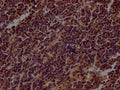 IHC image of CSB-RA798840A0HU diluted at 1:100 and staining in paraffin-embedded human lung cancer performed on a Leica BondTM system. After dewaxing and hydration, antigen retrieval was mediated by high pressure in a citrate buffer (pH 6.0) . Section was blocked with 10% normal goat serum 30min at RT. Then primary antibody (1% BSA) was incubated at 4℃ overnight. The primary is detected by a Goat anti-rabbit IgG polymer labeled by HRP and visualized using 0.05% DAB.