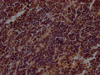 IHC image of CSB-RA798840A0HU diluted at 1:100 and staining in paraffin-embedded human lung cancer performed on a Leica BondTM system. After dewaxing and hydration, antigen retrieval was mediated by high pressure in a citrate buffer (pH 6.0) . Section was blocked with 10% normal goat serum 30min at RT. Then primary antibody (1% BSA) was incubated at 4℃ overnight. The primary is detected by a Goat anti-rabbit IgG polymer labeled by HRP and visualized using 0.05% DAB.