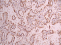 IHC image of CSB-RA799971A0HU diluted at 1:100 and staining in paraffin-embedded human lung cancer performed on a Leica BondTM system. After dewaxing and hydration, antigen retrieval was mediated by high pressure in a citrate buffer (pH 6.0) . Section was blocked with 10% normal goat serum 30min at RT. Then primary antibody (1% BSA) was incubated at 4°C overnight. The primary is detected by a Goat anti-rabbit polymer IgG labeled by HRP and visualized using 0.05% DAB.