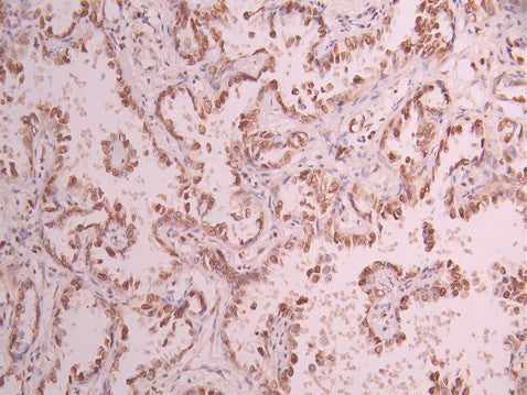 IHC image of CSB-RA799971A0HU diluted at 1:100 and staining in paraffin-embedded human lung cancer performed on a Leica BondTM system. After dewaxing and hydration, antigen retrieval was mediated by high pressure in a citrate buffer (pH 6.0) . Section was blocked with 10% normal goat serum 30min at RT. Then primary antibody (1% BSA) was incubated at 4°C overnight. The primary is detected by a Goat anti-rabbit polymer IgG labeled by HRP and visualized using 0.05% DAB.