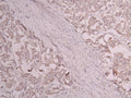 IHC image of CSB-RA801238MA1HU diluted at 1:300 and staining in paraffin-embedded human breast cancer performed on a Leica BondTM system. After dewaxing and hydration, antigen retrieval was mediated by high pressure in a citrate buffer (pH 6.0) . Section was blocked with 10% normal goat serum 30min at RT. Then primary antibody (1% BSA) was incubated at 4°C overnight. The primary is detected by a Goat anti-human polymer IgG labeled by HRP and visualized using 0.05% DAB.