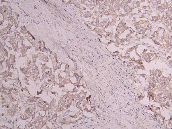 IHC image of CSB-RA801238MA1HU diluted at 1:300 and staining in paraffin-embedded human breast cancer performed on a Leica BondTM system. After dewaxing and hydration, antigen retrieval was mediated by high pressure in a citrate buffer (pH 6.0) . Section was blocked with 10% normal goat serum 30min at RT. Then primary antibody (1% BSA) was incubated at 4°C overnight. The primary is detected by a Goat anti-human polymer IgG labeled by HRP and visualized using 0.05% DAB.