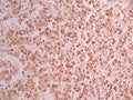 IHC image of CSB-RA821323A0HU diluted at 1:100 and staining in paraffin-embedded human breast cancer performed on a Leica BondTM system. After dewaxing and hydration, antigen retrieval was mediated by high pressure in a citrate buffer (pH 6.0) . Section was blocked with 10% normal goat serum 30min at RT. Then primary antibody (1% BSA) was incubated at 4°C overnight. The primary is detected by a Goat anti-rabbit polymer IgG labeled by HRP and visualized using 0.05% DAB.