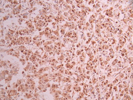 IHC image of CSB-RA821323A0HU diluted at 1:100 and staining in paraffin-embedded human breast cancer performed on a Leica BondTM system. After dewaxing and hydration, antigen retrieval was mediated by high pressure in a citrate buffer (pH 6.0) . Section was blocked with 10% normal goat serum 30min at RT. Then primary antibody (1% BSA) was incubated at 4°C overnight. The primary is detected by a Goat anti-rabbit polymer IgG labeled by HRP and visualized using 0.05% DAB.