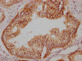 IHC image of CSB-RA827145A0HU diluted at 1:100 and staining in paraffin-embedded human prostate cancer performed on a Leica BondTM system. After dewaxing and hydration, antigen retrieval was mediated by high pressure in a citrate buffer (pH 6.0) . Section was blocked with 10% normal goat serum 30min at RT. Then primary antibody (1% BSA) was incubated at 4℃ overnight. The primary is detected by a Goat anti-rabbit IgG polymer labeled by HRP and visualized using 0.05% DAB.