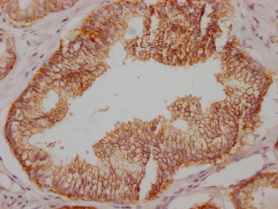 IHC image of CSB-RA827145A0HU diluted at 1:100 and staining in paraffin-embedded human prostate cancer performed on a Leica BondTM system. After dewaxing and hydration, antigen retrieval was mediated by high pressure in a citrate buffer (pH 6.0) . Section was blocked with 10% normal goat serum 30min at RT. Then primary antibody (1% BSA) was incubated at 4℃ overnight. The primary is detected by a Goat anti-rabbit IgG polymer labeled by HRP and visualized using 0.05% DAB.