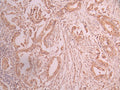 IHC image of CSB-RA827308A0HU diluted at 1:100 and staining in paraffin-embedded human cervical cancer performed on a Leica BondTM system. After dewaxing and hydration, antigen retrieval was mediated by high pressure in a citrate buffer (pH 6.0) . Section was blocked with 10% normal goat serum 30min at RT. Then primary antibody (1% BSA) was incubated at 4°C overnight. The primary is detected by a Goat anti-rabbit polymer IgG labeled by HRP and visualized using 0.05% DAB.