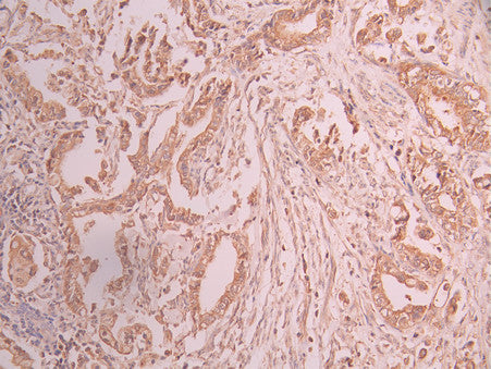 IHC image of CSB-RA827308A0HU diluted at 1:100 and staining in paraffin-embedded human cervical cancer performed on a Leica BondTM system. After dewaxing and hydration, antigen retrieval was mediated by high pressure in a citrate buffer (pH 6.0) . Section was blocked with 10% normal goat serum 30min at RT. Then primary antibody (1% BSA) was incubated at 4°C overnight. The primary is detected by a Goat anti-rabbit polymer IgG labeled by HRP and visualized using 0.05% DAB.