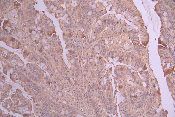 IHC image of CSB-RA829042A0HU diluted at 1:100 and staining in paraffin-embedded human colorectal cancer performed on a Leica BondTM system. After dewaxing and hydration, antigen retrieval was mediated by high pressure in a citrate buffer (pH 6.0) . Section was blocked with 10% normal goat serum 30min at RT. Then primary antibody (1% BSA) was incubated at 4°C overnight. The primary is detected by a Goat anti-rabbit polymer IgG labeled by HRP and visualized using 0.05% DAB.