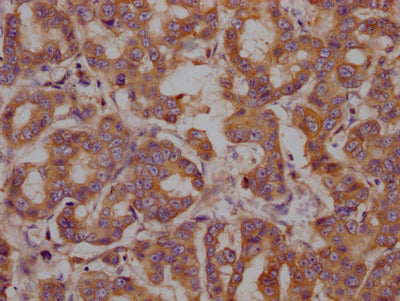 IHC image of CSB-RA847116A0HU diluted at 1:100 and staining in paraffin-embedded human breast cancer performed on a Leica BondTM system. After dewaxing and hydration, antigen retrieval was mediated by high pressure in a citrate buffer (pH 6.0) . Section was blocked with 10% normal goat serum 30min at RT. Then primary antibody (1% BSA) was incubated at 4℃ overnight. The primary is detected by a Goat anti-rabbit IgG polymer labeled by HRP and visualized using 0.05% DAB.