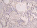 IHC image of CSB-RA878931MA1HU diluted at 1:100 and staining in paraffin-embedded human prostate cancer performed on a Leica BondTM system. After dewaxing and hydration, antigen retrieval was mediated by high pressure in a citrate buffer (pH 6.0) . Section was blocked with 10% normal goat serum 30min at RT. Then primary antibody (1% BSA) was incubated at 4°C overnight. The primary is detected by a Goat anti-human polymer IgG labeled by HRP and visualized using 0.05% DAB.