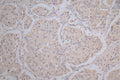 IHC image of CSB-RA878942MA1HU diluted at 1:100 and staining in paraffin-embedded human lung cancer performed on a Leica BondTM system. After dewaxing and hydration,  antigen retrieval was mediated by high pressure in a citrate buffer (pH 6.0) . Section was blocked with 10% normal goat serum 30min at RT. Then primary antibody (1% BSA) was incubated at 4°C overnight. The primary is detected by a Goat anti-Mouse IgG labeled by HRP and visualized using 0.05% DAB.