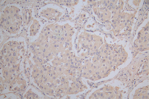 IHC image of CSB-RA878942MA1HU diluted at 1:100 and staining in paraffin-embedded human lung cancer performed on a Leica BondTM system. After dewaxing and hydration,  antigen retrieval was mediated by high pressure in a citrate buffer (pH 6.0) . Section was blocked with 10% normal goat serum 30min at RT. Then primary antibody (1% BSA) was incubated at 4°C overnight. The primary is detected by a Goat anti-Mouse IgG labeled by HRP and visualized using 0.05% DAB.